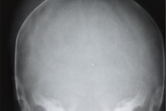 cefalohematoma-parietal-der-1991-005