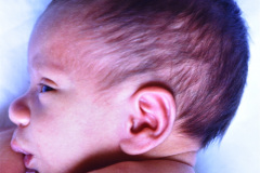 cefalohematoma-parietal-der-001