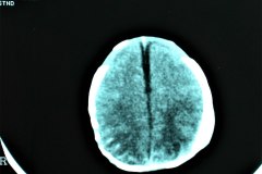 cefalohematoma-parietal-izq-tac-1996-000