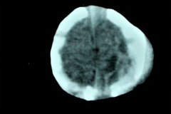 cefalohematoma-parietal-izq-tac-1996-001