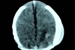 cefalohematoma-parietal-izq-tac-1996-002