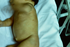 cefalohematoma-parietal-izq-001