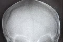 cefalohematoma-post-natal-trauma-craneoencefalico-caida-cama-1990-001