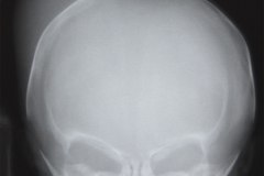 cefalohematoma-000