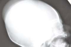 cefalohematoma-001