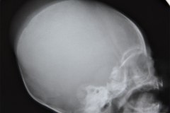 cefalohematoma-002