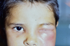 celulitis-periorbitaria-000