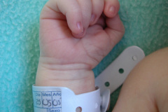 celulitis-tenar-izq-edema-del-pulgar-onfalitis-2005-000