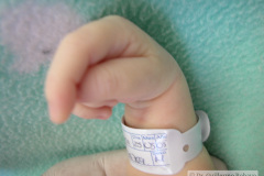 celulitis-tenar-izq-edema-del-pulgar-onfalitis-2005-005