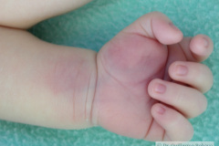 celulitis-tenar-izq-edema-del-pulgar-onfalitis-2005-007