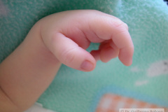 celulitis-tenar-izq-edema-del-pulgar-onfalitis-2005-009