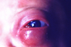 celultis-periorbitaria-blefaritis-absceso-palpebral-izq-002