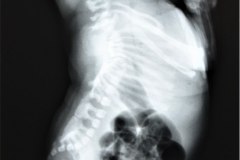 cerebro-costo-mandibular-pterigios-multiples-000
