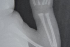 cerebro-costo-mandibular-pterigios-multiples-007