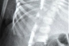 cerebro-costo-mandibular-pterigios-multiples-014