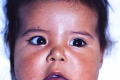 cianosis-labial-000