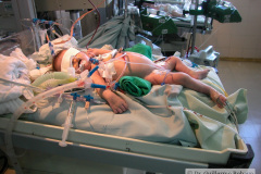cirugia-corazon-con-circulacion-extracorporea-postop-2004-000