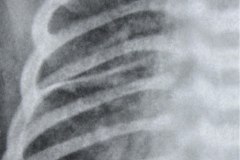 cisuritis-der-000