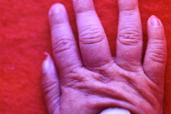 clinodactilia-bil-manos-001