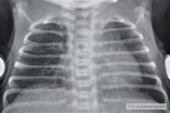 coartacion-aorta-cardiomegalia-e-hiperflujo-pulmonar-postop-2005-001