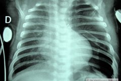 coartacion-aorta-cardiomegalia-postop-neumotorax-tubo-torax-2004-001