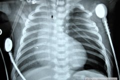 coartacion-aorta-cardiomegalia-postop-neumotorax-tubo-torax-2004-002