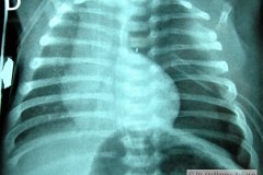 coartacion-aorta-cardiomegalia-postop-neumotorax-tubo-torax-2004-004
