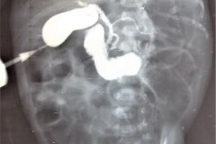 colangiopancreatografia-percutanea-000