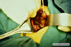 colicistectomia-000