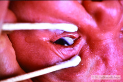 coloboma-ojo-izq-1985-002