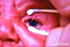 coloboma-ojo-izq-1985-004