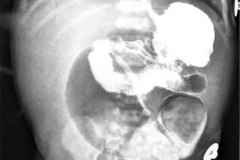 colon-hipoplasico-atonico-atresia-ileon-vias-digestivas-colon-por-enema-2005-000