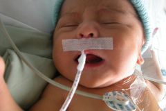 colon-hipoplasico-atresia-ileocecal-hematoquecia-2005-008