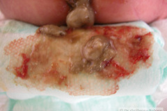 colon-hipoplasico-atresia-ileocecal-hematoquecia-2005-010