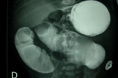 colon-hipoplasico-atresia-ileocecal-hematoquecia-2005-012