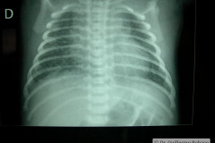 colon-hipoplasico-atresia-ileocecal-hematoquecia-2005-013