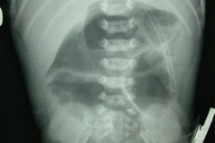 colon-hipoplasico-atresia-ileocecal-hematoquecia-2005-014