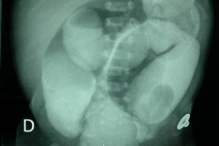 colon-hipoplasico-atresia-ileocecal-hematoquecia-2005-015