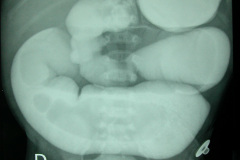 colon-hipoplasico-atresia-ileocecal-hematoquecia-2005-016