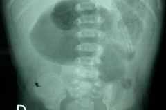 colon-hipoplasico-atresia-ileocecal-hematoquecia-2005-021