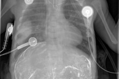 colon-por-enema-perforacion-intestinal-peritoneograma-2008-000