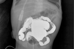 colon-por-enema-perforacion-intestinal-peritoneograma-2008-006