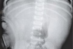 colostomia-doble-boca-2005-000