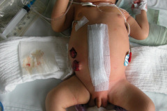 colostomia-doble-boca-001