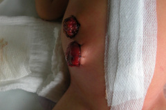 colostomia-doble-boca-002