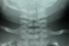 columna-cervical-normal-1988-000