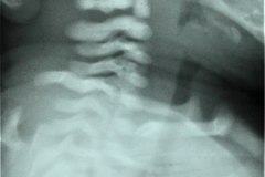 columna-cervical-normal-1988-001
