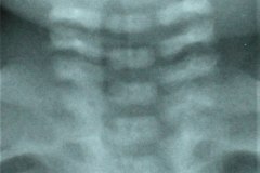 columna-cervical-normal-1994-000