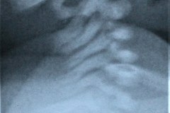 columna-cervical-normal-1994-001