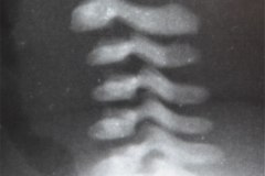 columna-cervical-normal-1996-001